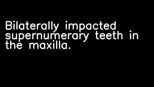 Bilaterally impacted supernumerary teeth in the maxilla.