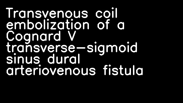 Transvenous coil embolization of a Cognard V transverse-sigmoid sinus dural arteriovenous fistula